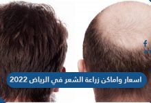 اسعار واماكن زراعة الشعر في الرياض 2022