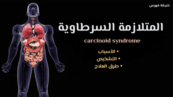 المتلازمة السرطاوية Carcinoid syndrome | التشخيص | طرق العلاج